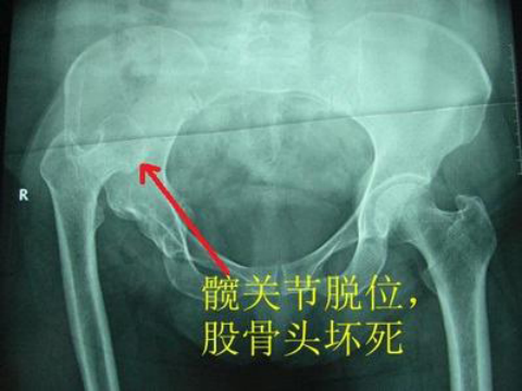 骨痹，右股骨頭壞死中醫(yī)醫(yī)案
